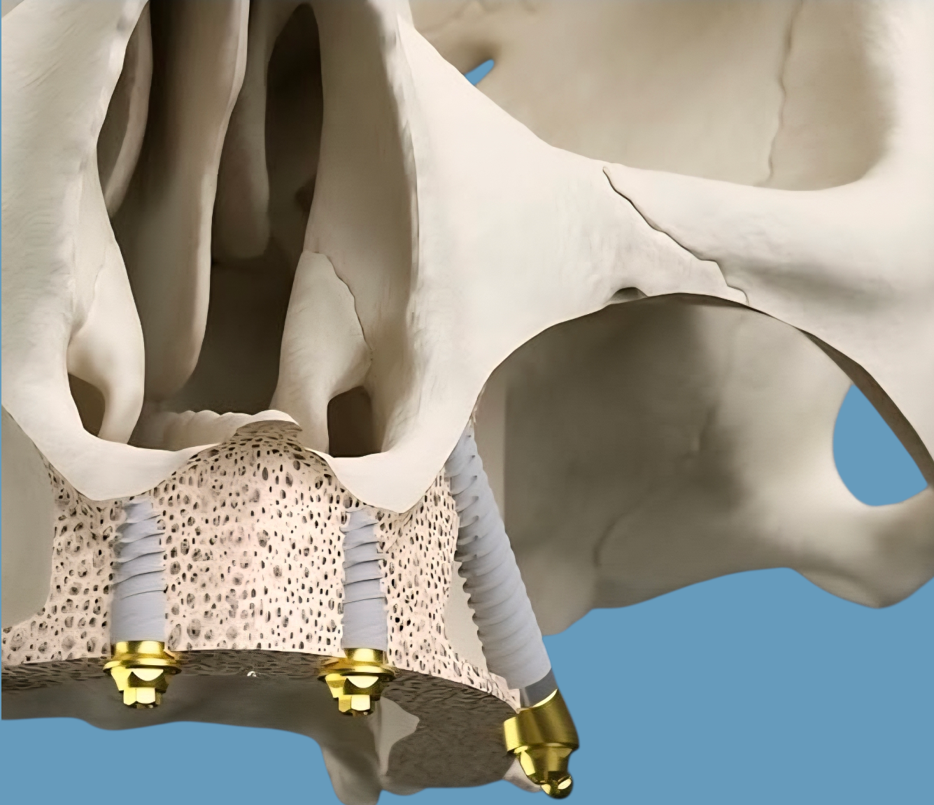 Reabilitari complexe cu implanturi dentare